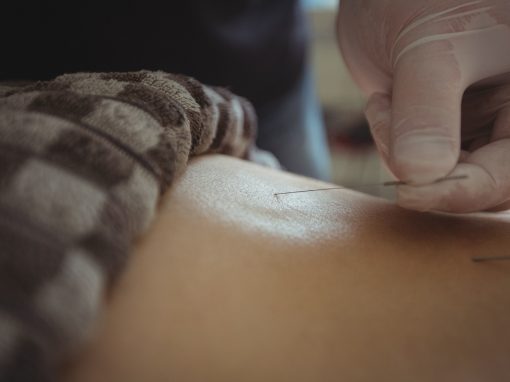 Acupuncture